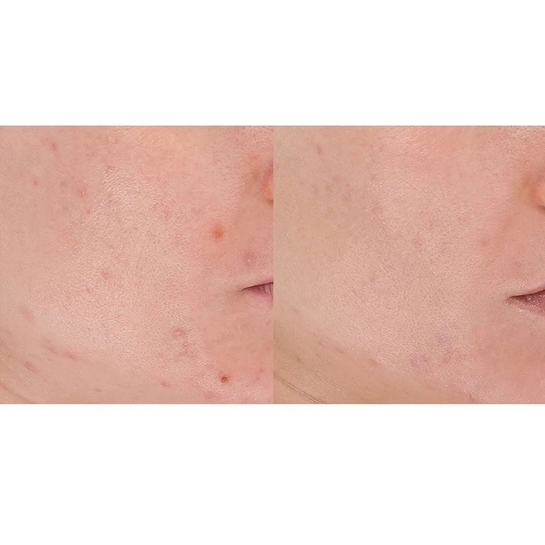 LightStim for Acne | LightStim